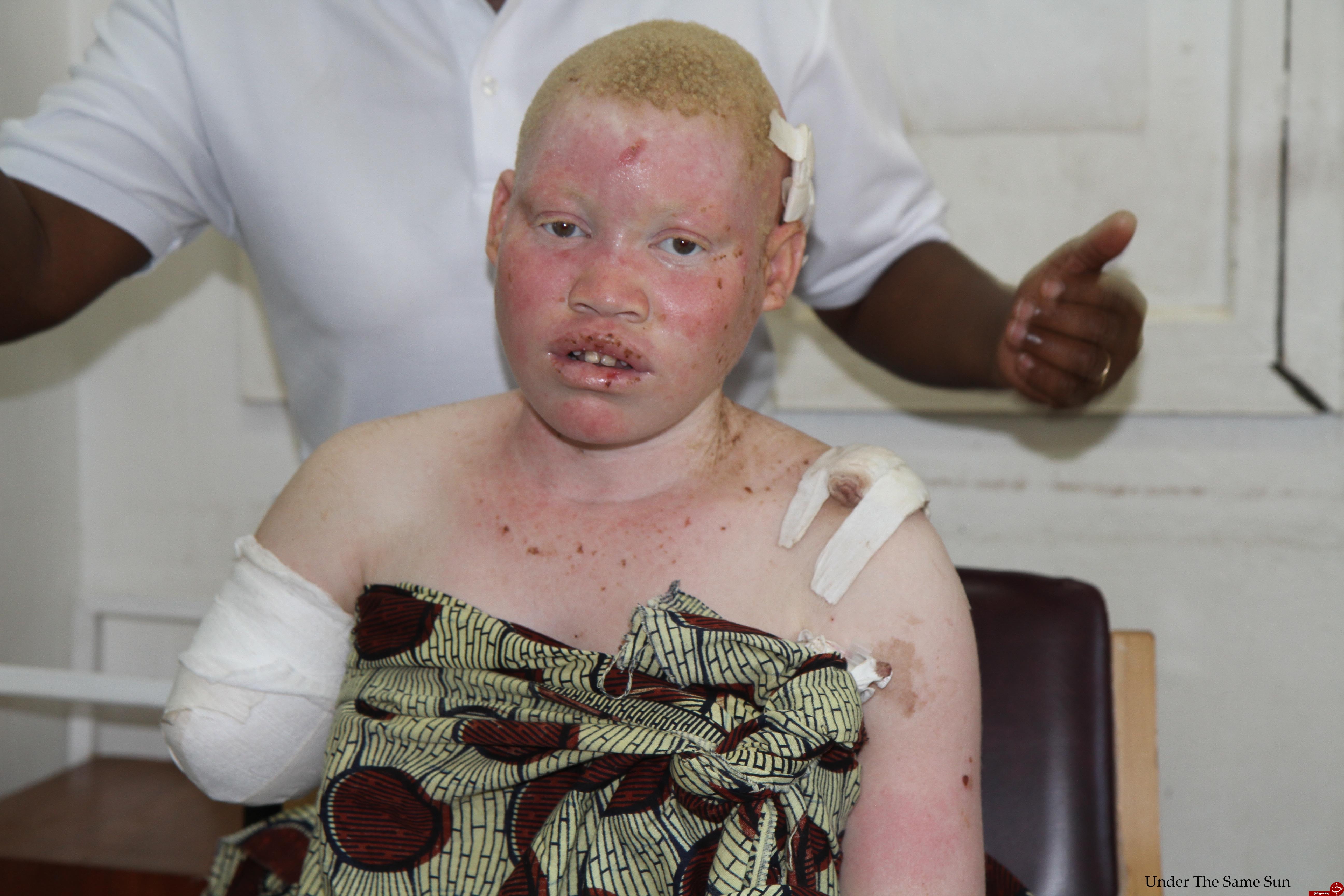 سرنوشت دردناک کودکان آلبینو در تانزانیا+ تصاویر
