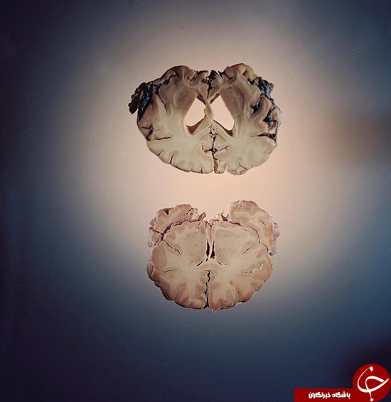 تأثیر آلزایمر روی مغز چگونه است؟ +عکس